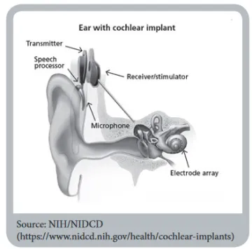 image of ear with cochlear implant image of ear with cochlear implant